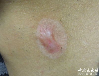 淺析放射性同位素敷貼治療方法_儀器修復_疤痕修復_中國疤痕網 - 您身邊的疤痕修復專家